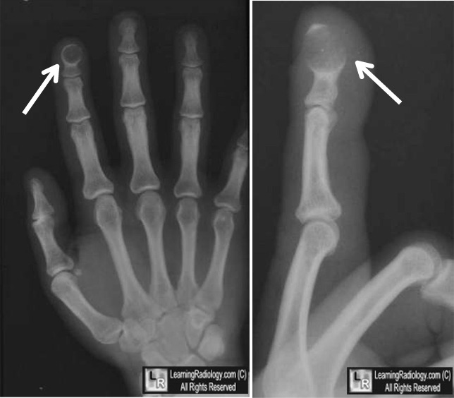 Epidermal Inclusion Cyst